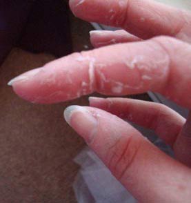 bőrkezelés az ujjak között