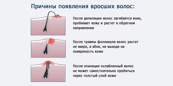 hogyan lehet eltávolítani a vörös foltokat a benőtt hajból)